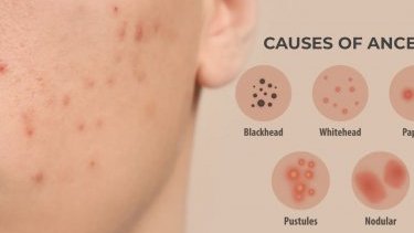 Мифы об акне